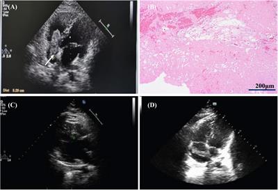 Case report: A rare case of recurrent right atrial mass dramatically disappeared after anticoagulation